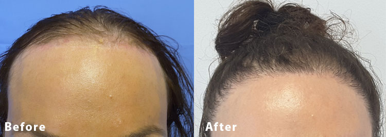 transgender hair transplant before after